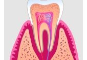 root_canal1